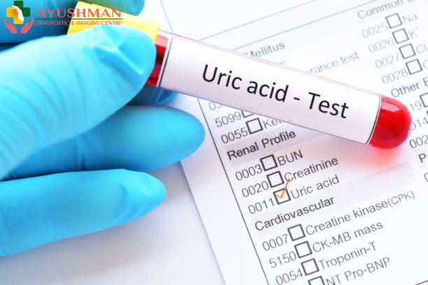 Uric Acid Test in Delhi