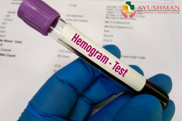 Hemogram Test in Dwarka: Understanding Your Blood Cell Health
