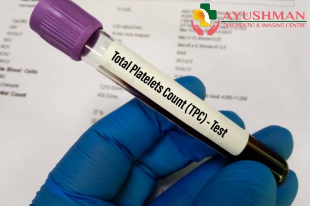 Platelet Count Blood Test in Dwarka